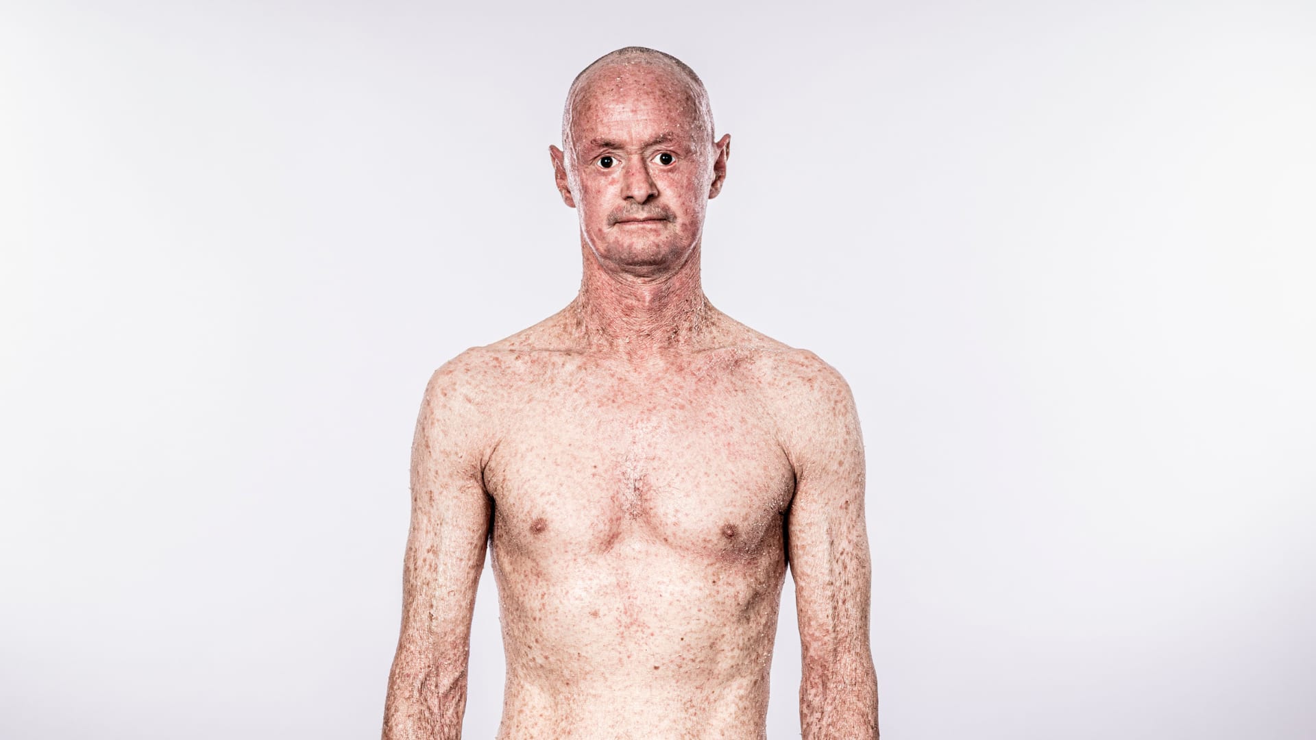 Faces of Ichthyosis: Anthony