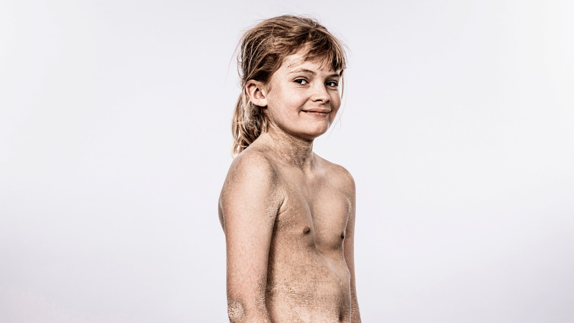 Faces of Ichthyosis: Daniel